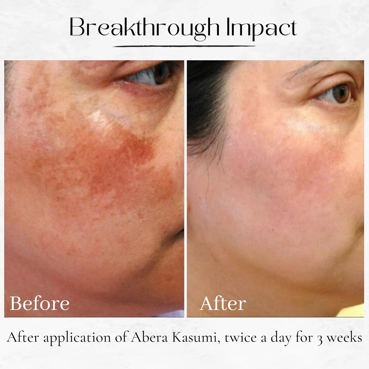 ABERA Kasumi Glowing Cream, Melasma Treatment with Niacinamide & HA, Dark Spot Remover For Face, Reduce Fine Lines, Wrinkles, Anti-aging, Red Ginseng Extract, Melasma Cream (0.7 Oz Per Item)