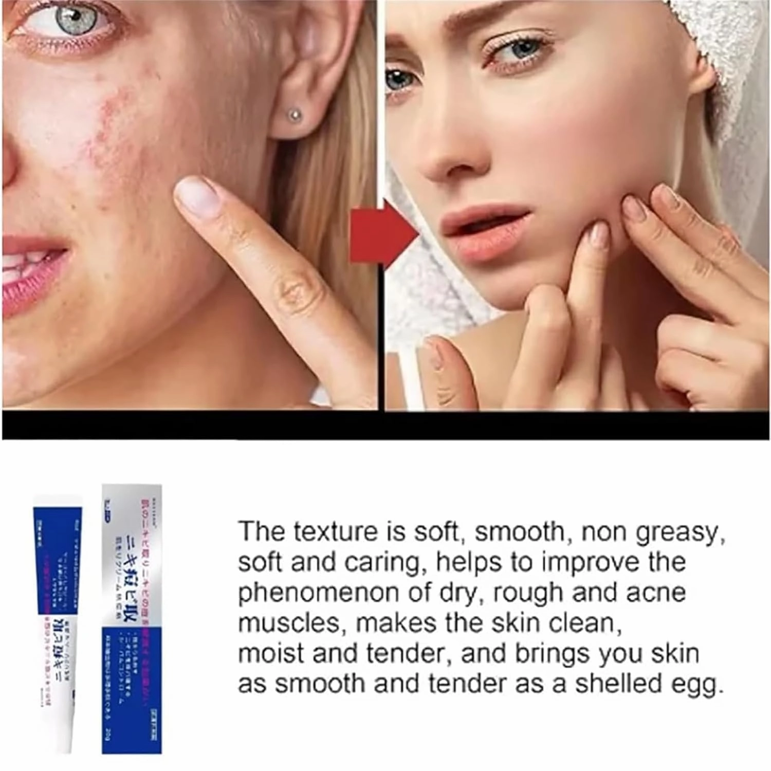 Acne Cream, 20g，Natural Acne Gel for Face，Japanese Moisturizing Treatment for Women & Men (3)