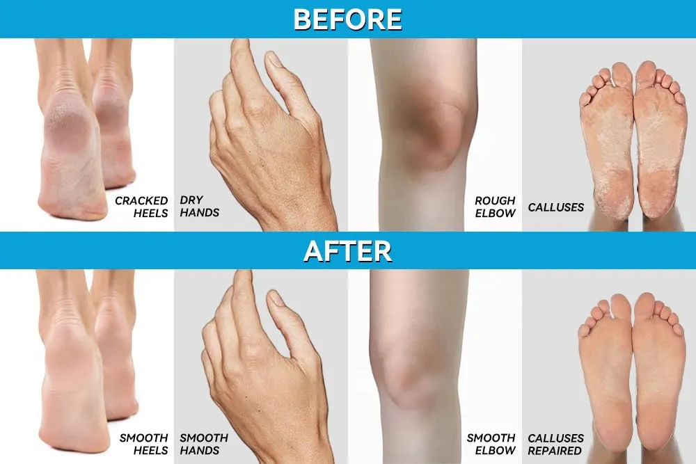 CLEAR Urea Cream 40%   1% Hyaluronic Acid (4oz) | Softens Cracked Heels & Dry Skin Urea Cream 40 Percent - Infused w Tea Tree & Coconut Oil | Callus & Corn Treatment | Made in USA