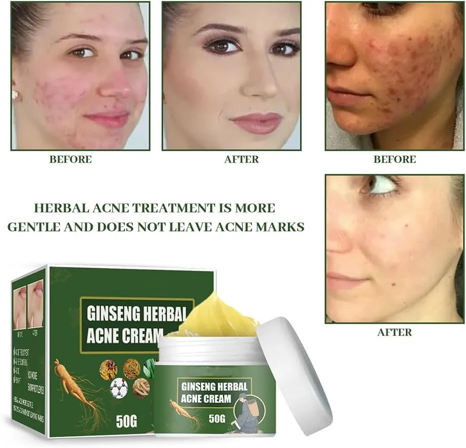 Ginseng Herbal Acne Cleansing Cream, Fading Acne Scar, Removing Acne, Repairing Acne Pit and Moisturizing, Cleaning And Brightening Acne Cream (3)
