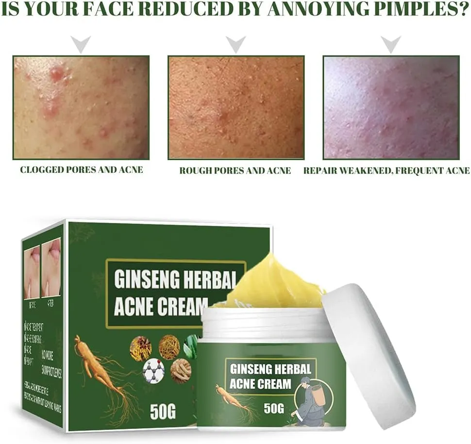 Ginseng Herbal Acne Cleansing Cream, Fading Acne Scar, Removing Acne, Repairing Acne Pit and Moisturizing, Cleaning And Brightening Acne Cream (3)